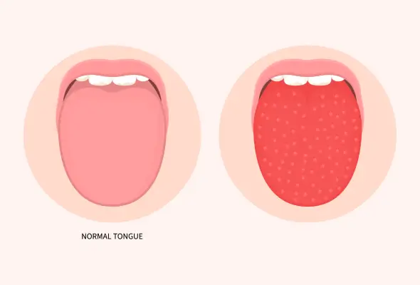 Swollen Tongue